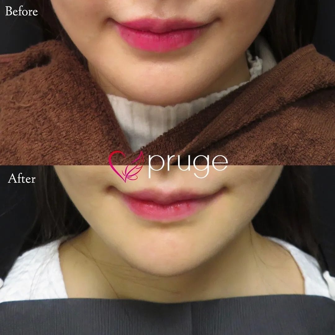 PRP注射（アゴ）