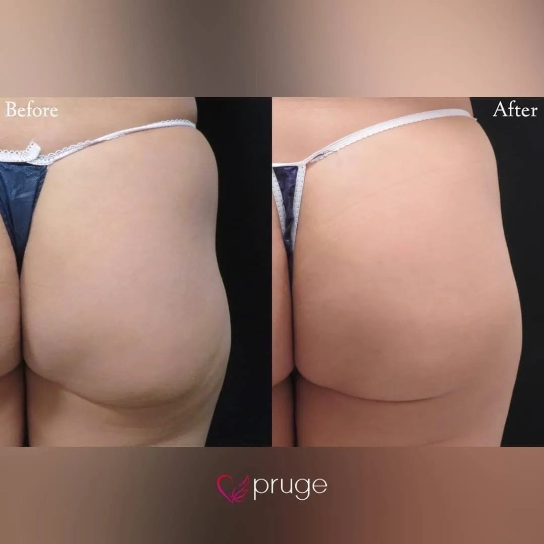 PRP注射によるヒップ形成