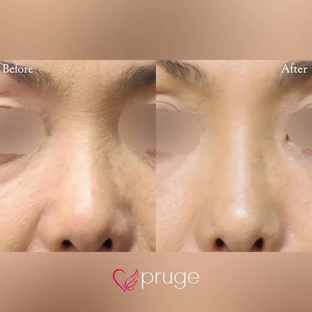 PRP注射（鼻根）