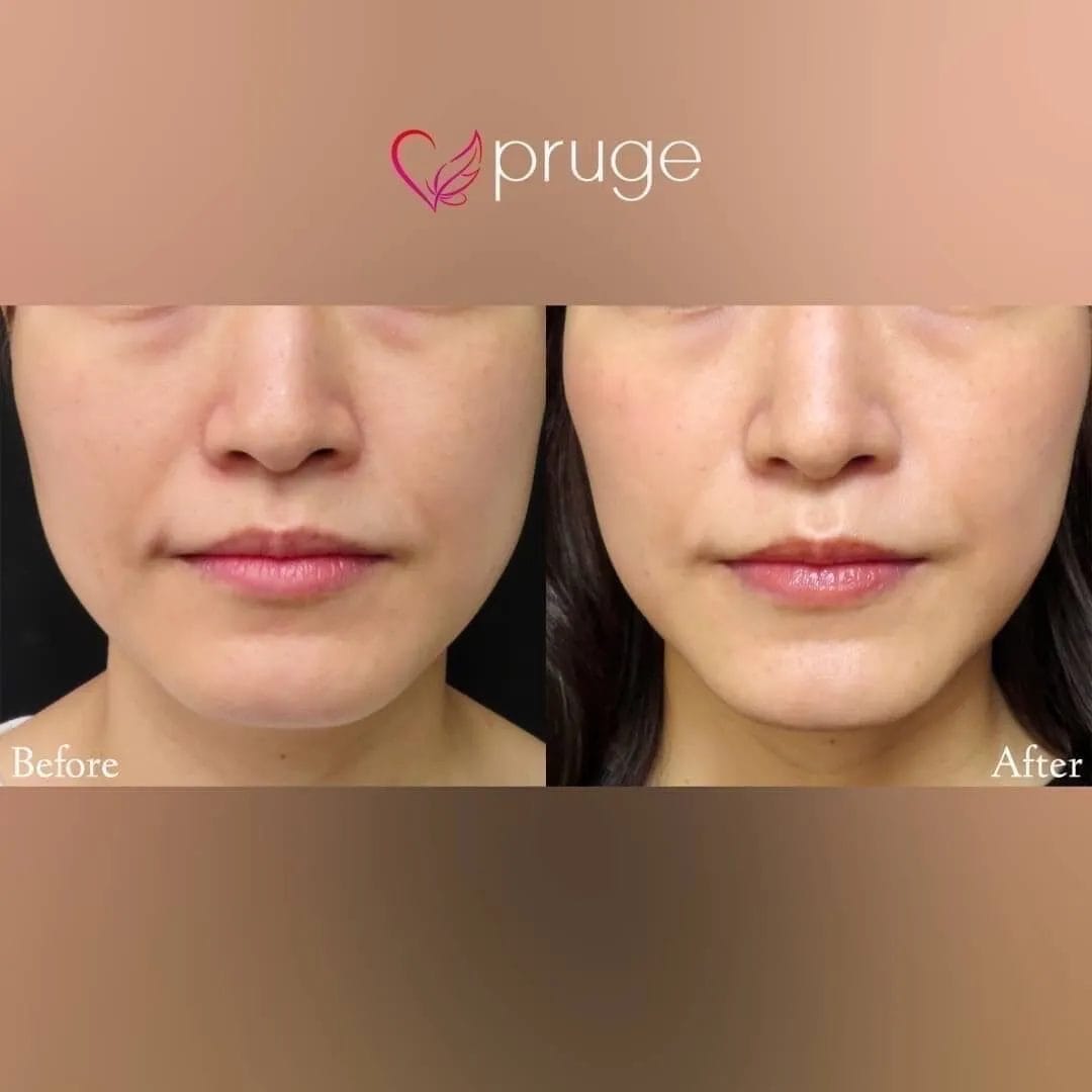 ｐスリム注射（フェイスライン・ほうれい線上）