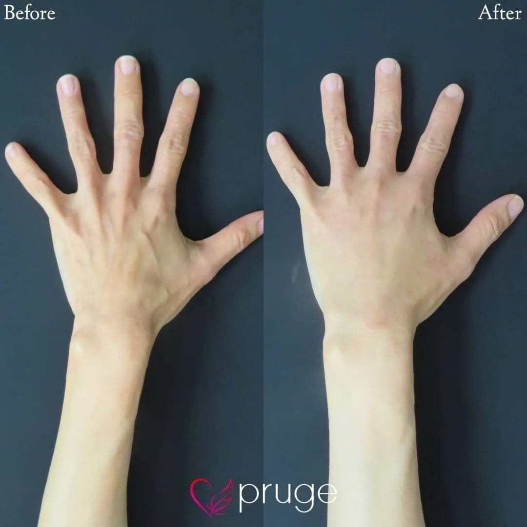 PRP注射（手の甲）