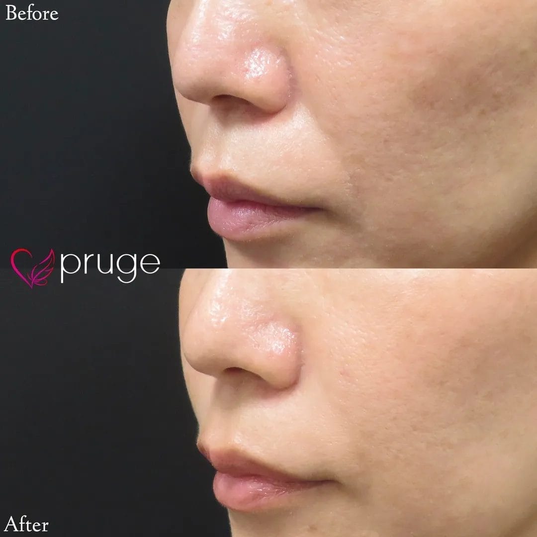 PRP注射（ほうれい線）