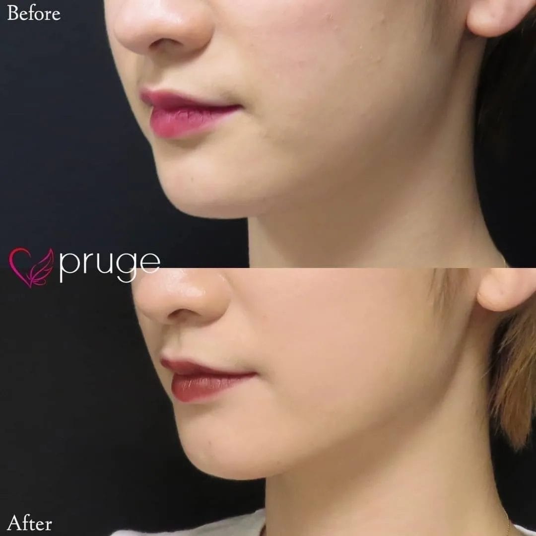 ｐスリム注射（フェイスライン）