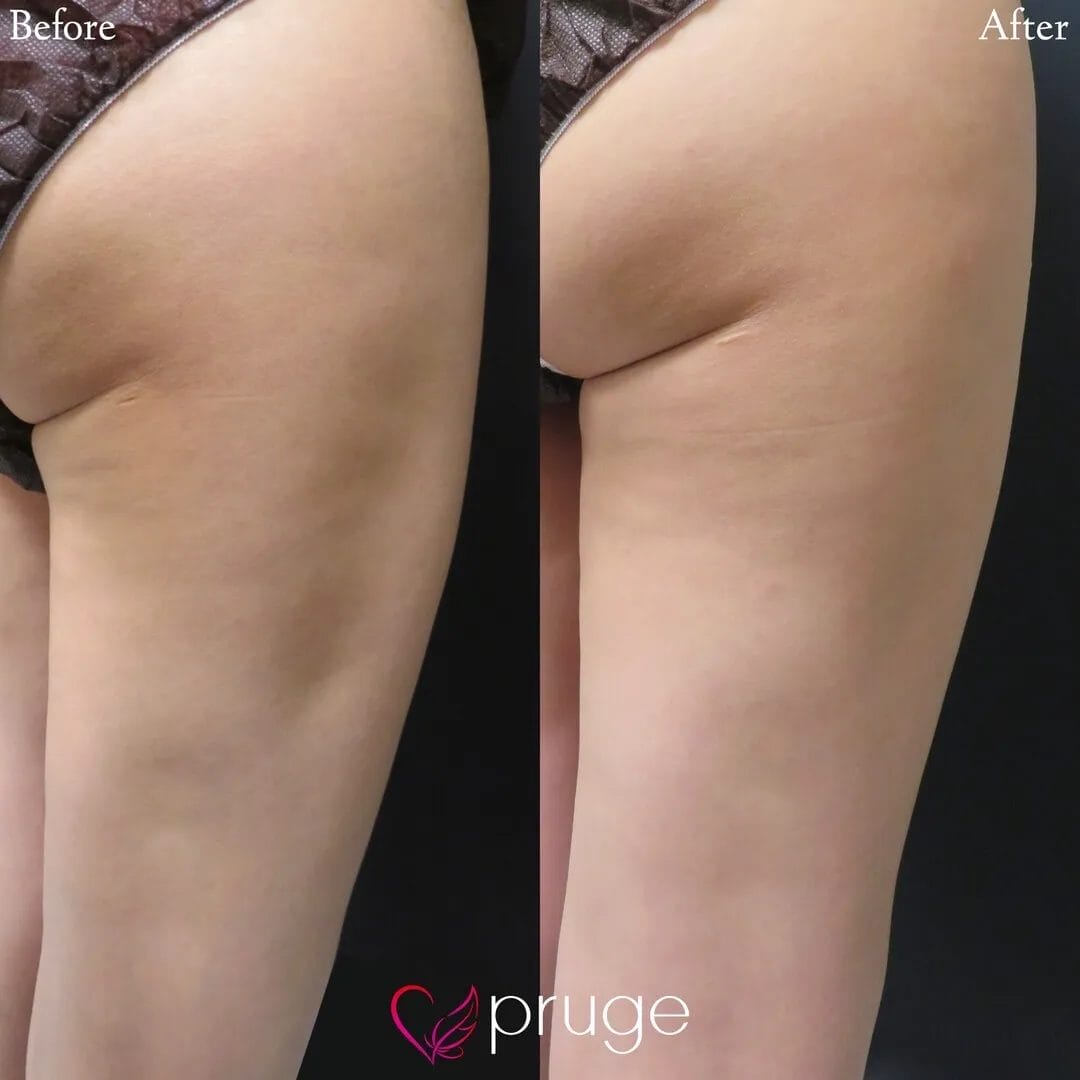 脂肪吸引後修正（太もも）