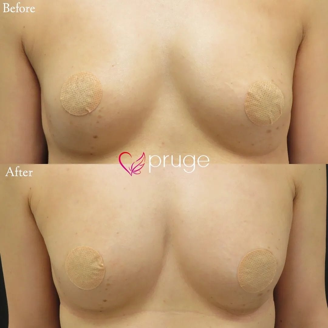 PRP注射によるバストアップ