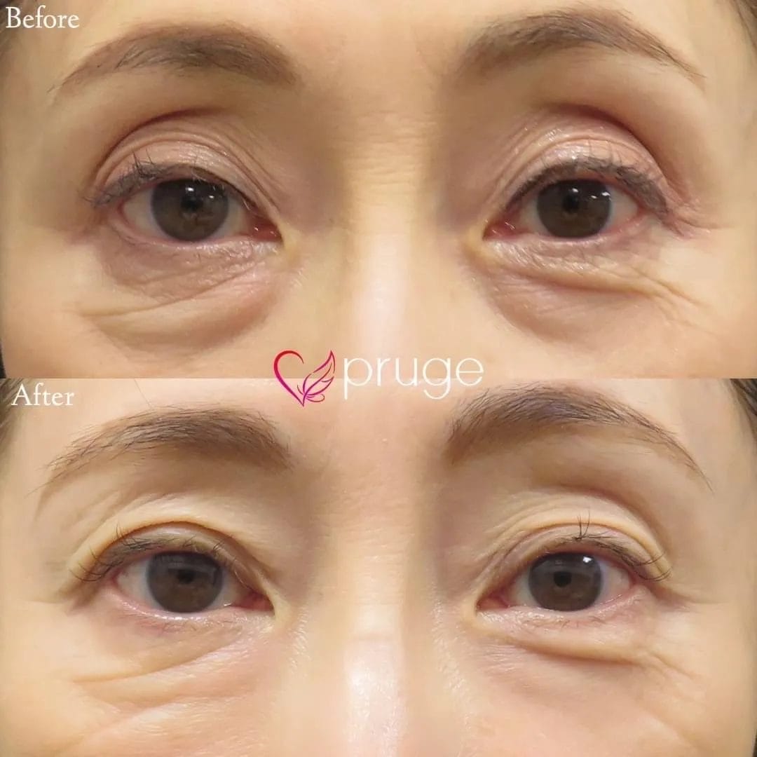 PRP注射（目の上・目の下）