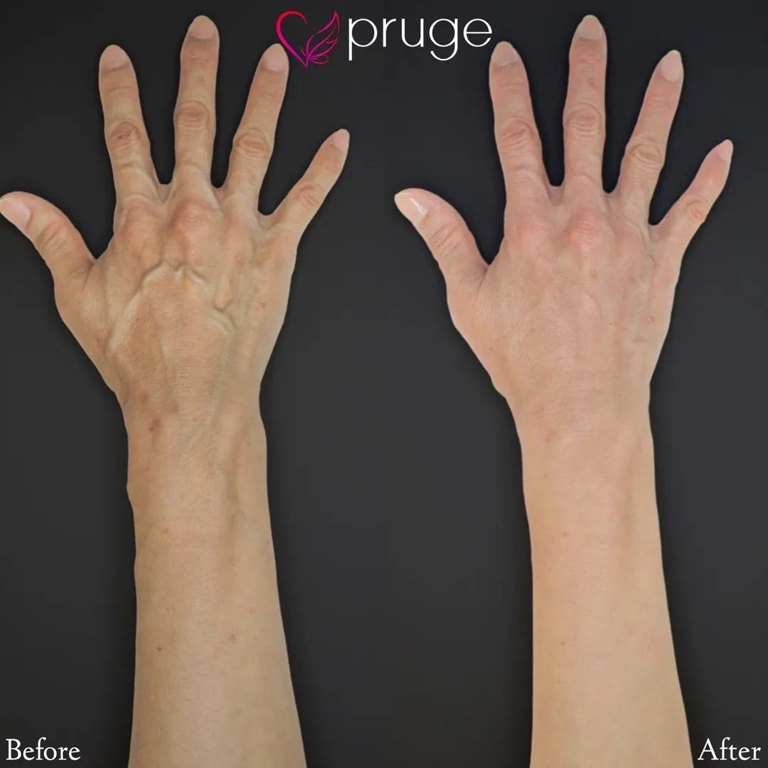 ハンドベイン（手の甲）