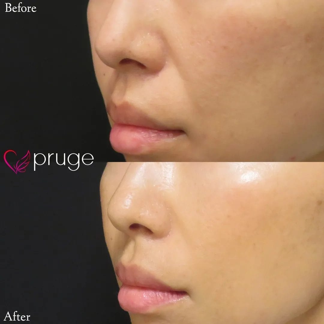 PRP注射（ほうれい線）