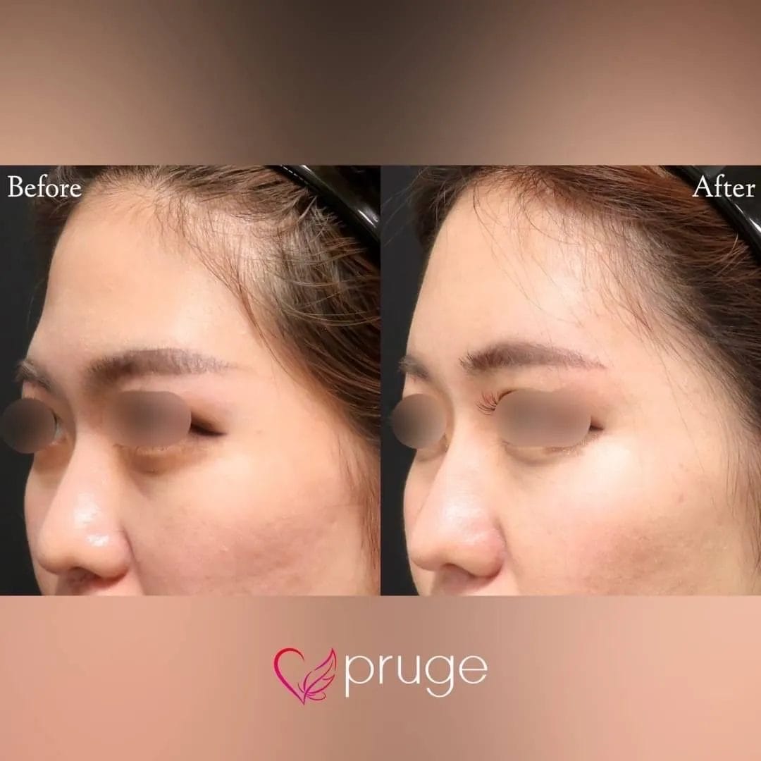 PRP注射（ひたい・こめかみ・鼻根・鼻尖）