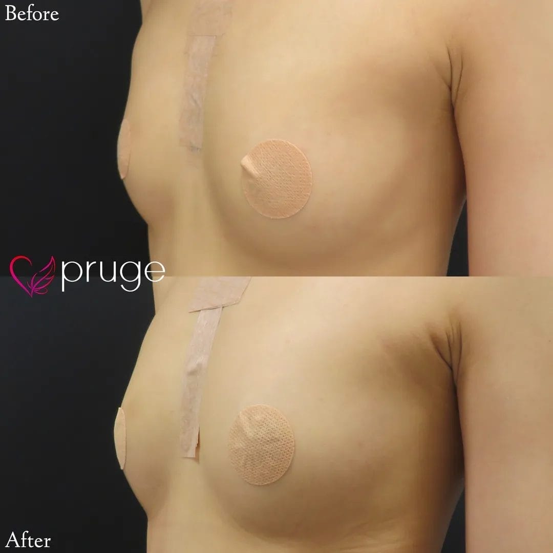 PRP注射によるバストアップ