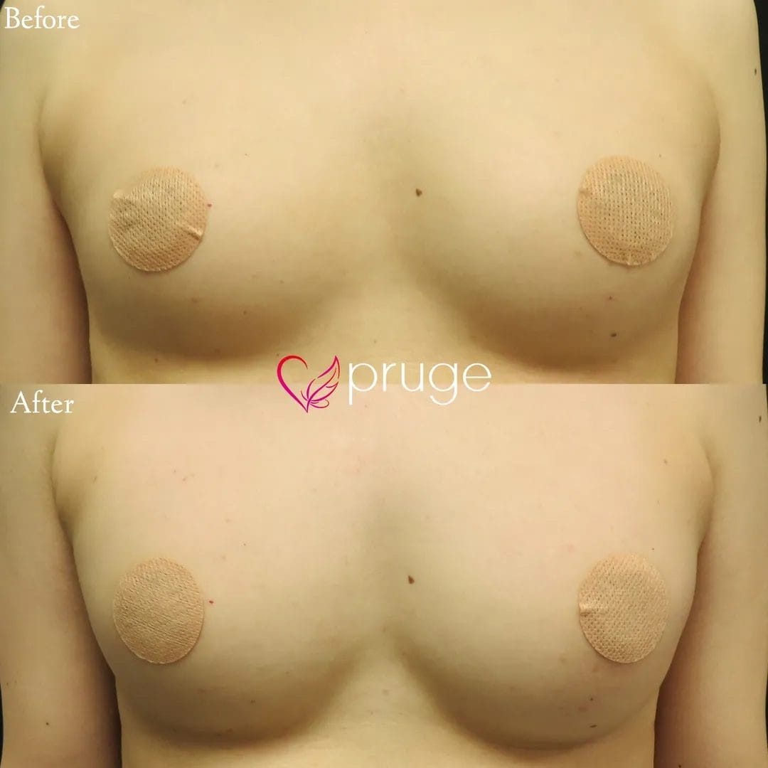 PRP注射によるバストアップ