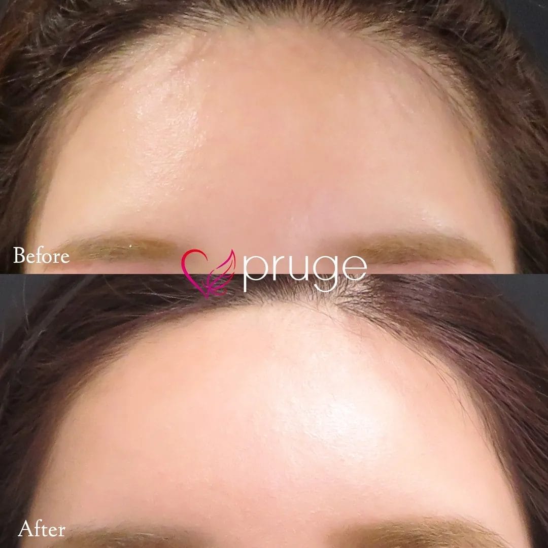 額・こめかみの凹み