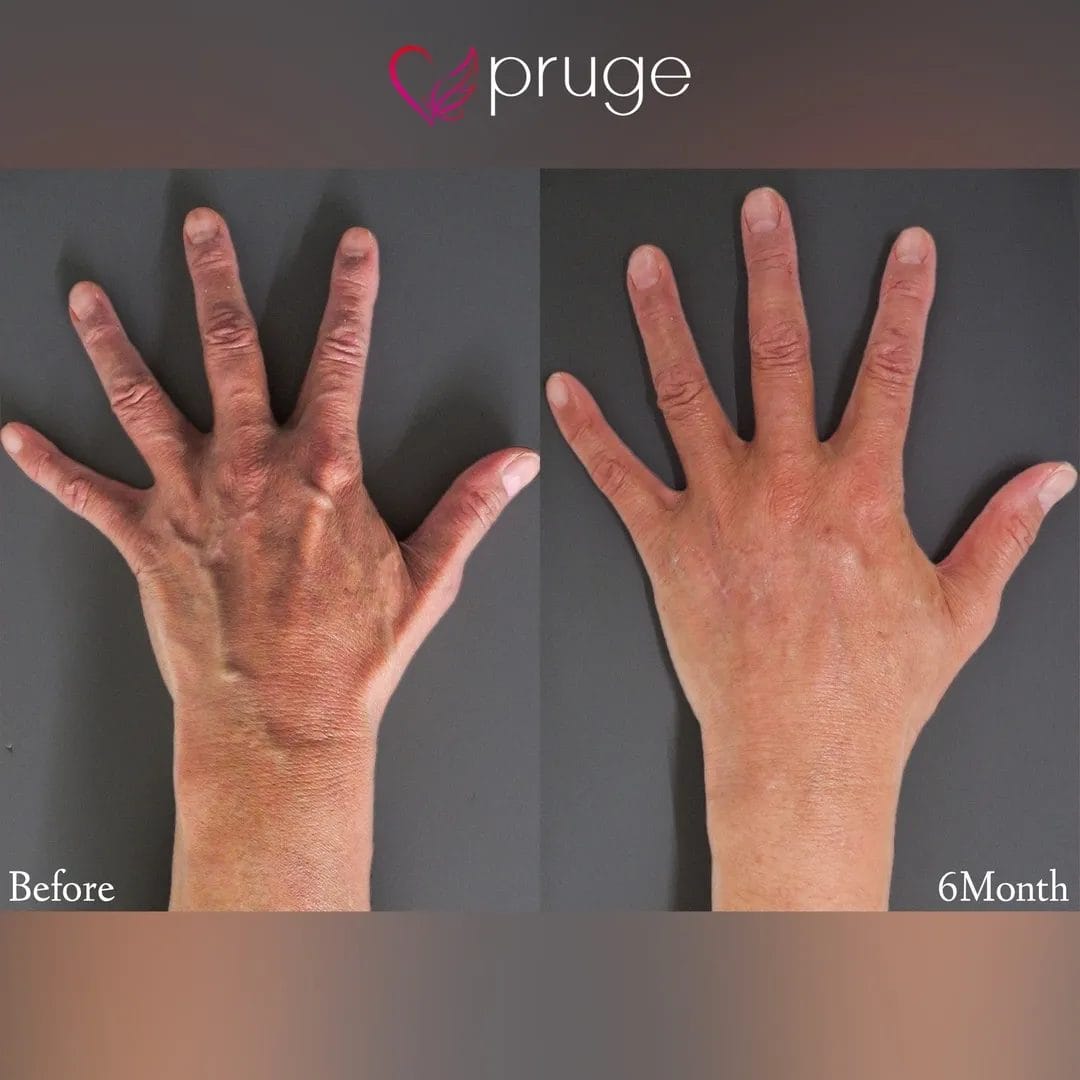 PRP注射（手の甲）・ハンドベイン