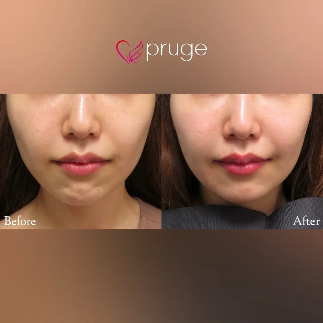 ホホのくぼみは加齢による症状というだけでなく、骨格などが原因でくぼんでしまう場合もあります…