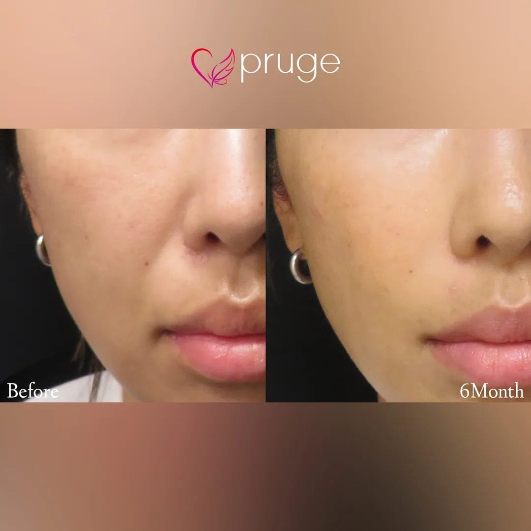 PRP注射（ほうれい線）