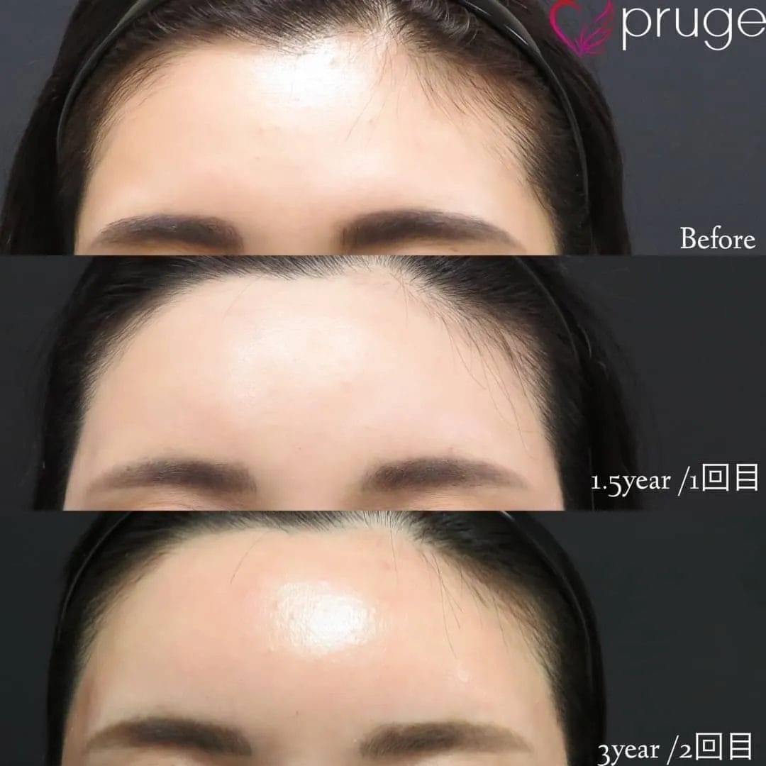 PRP注射(ひたい・こめかみ丸み形成)