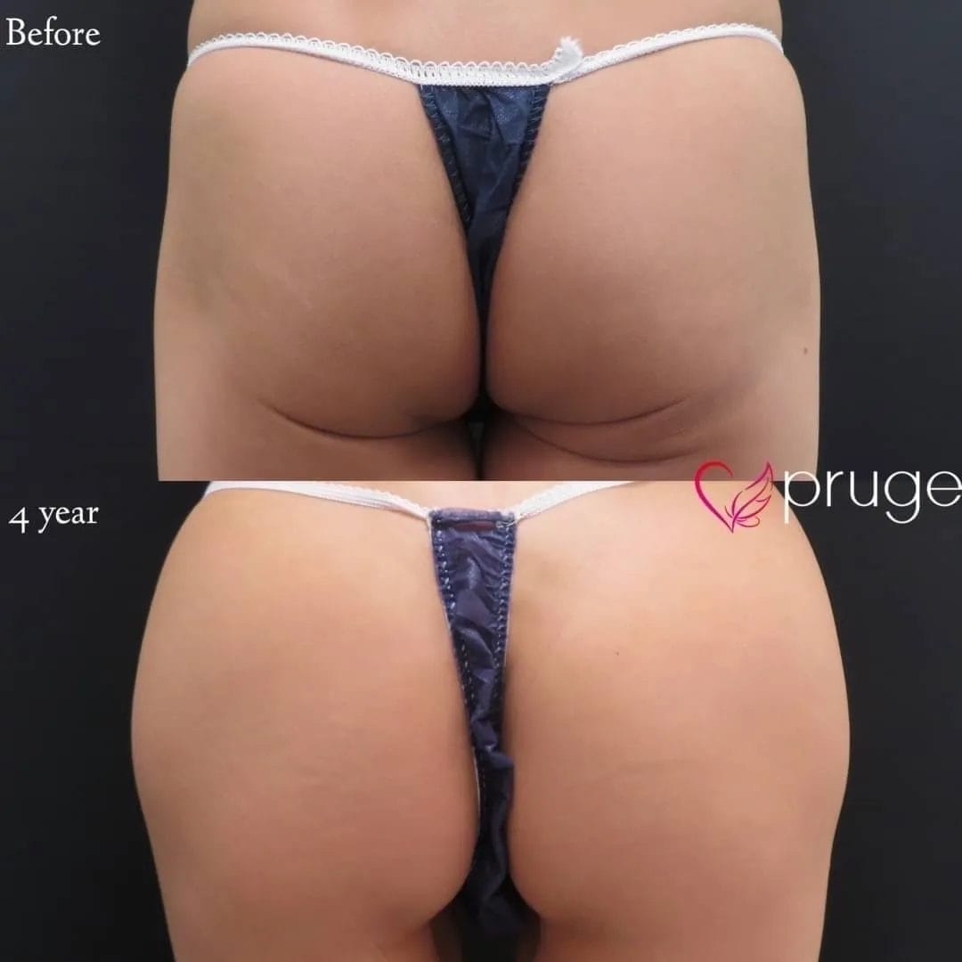 PRP注射はご自分の皮膚再生による豊尻術なので、脂肪吸引の必要もなく、形やさわり心地も自然で効果も半永久です。