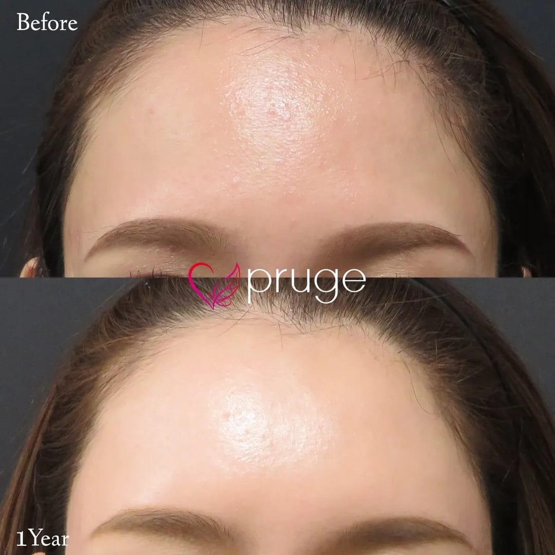 額・こめかみの凹み