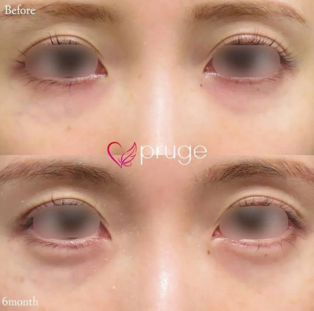 PRP注射（涙袋）