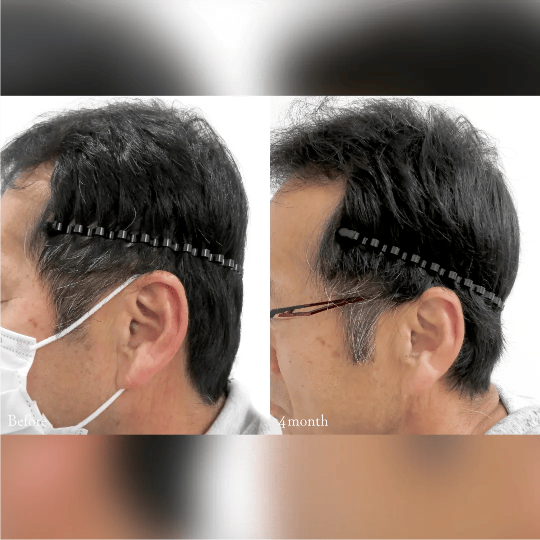 PRP注射による後頭部形成術