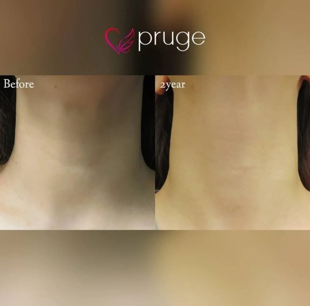 首元のシワには様々な治療方法がありますが、PRP注射はご自身の血液を使用した再生医療で、お肌の内側からふっくら。