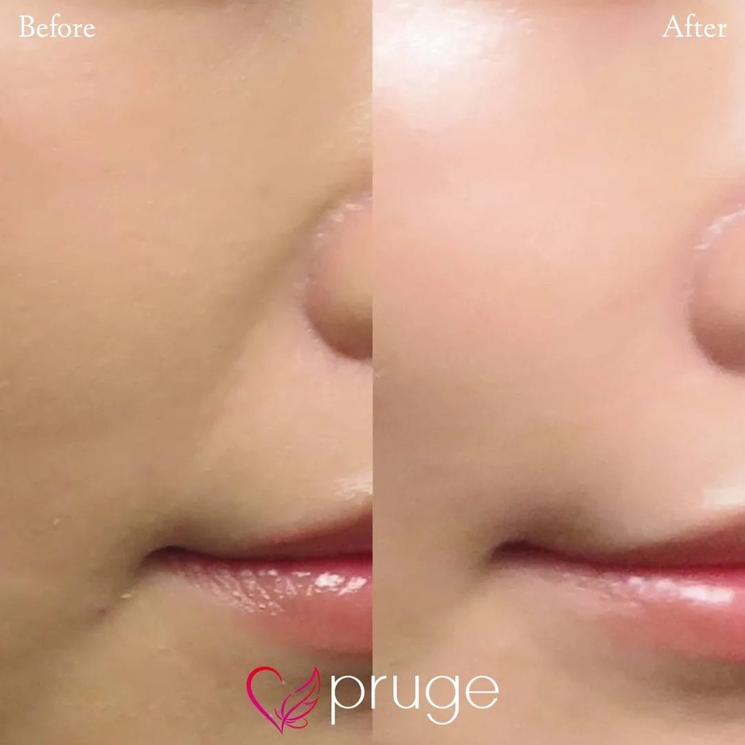 ご自身の血液から抽出したPRPを皮下組織に注入し、組織の修復効果が得られることで、症状が改善します。