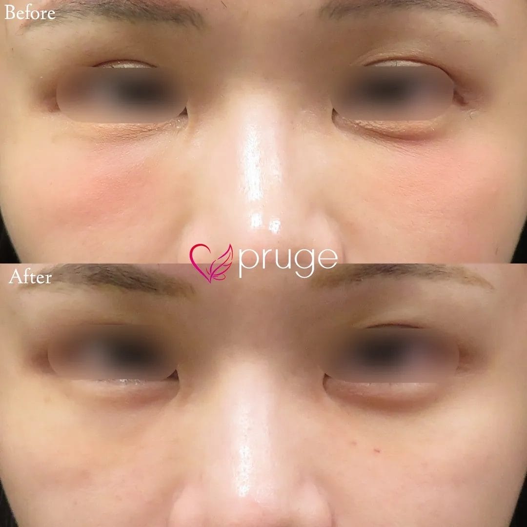 PRP＋FGF注射によって、ふくらみすぎてしまった部分にPRPG修正治療を行いました。