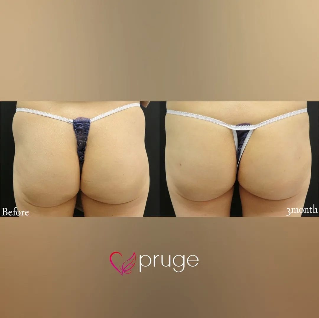 PRP注射によるヒップ形成