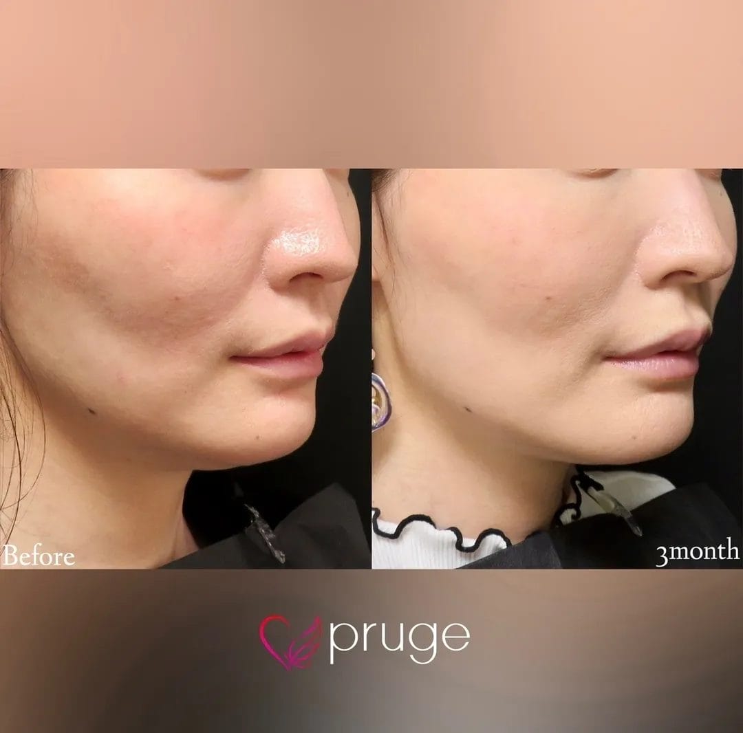 PRP注射（ホホのコケ）