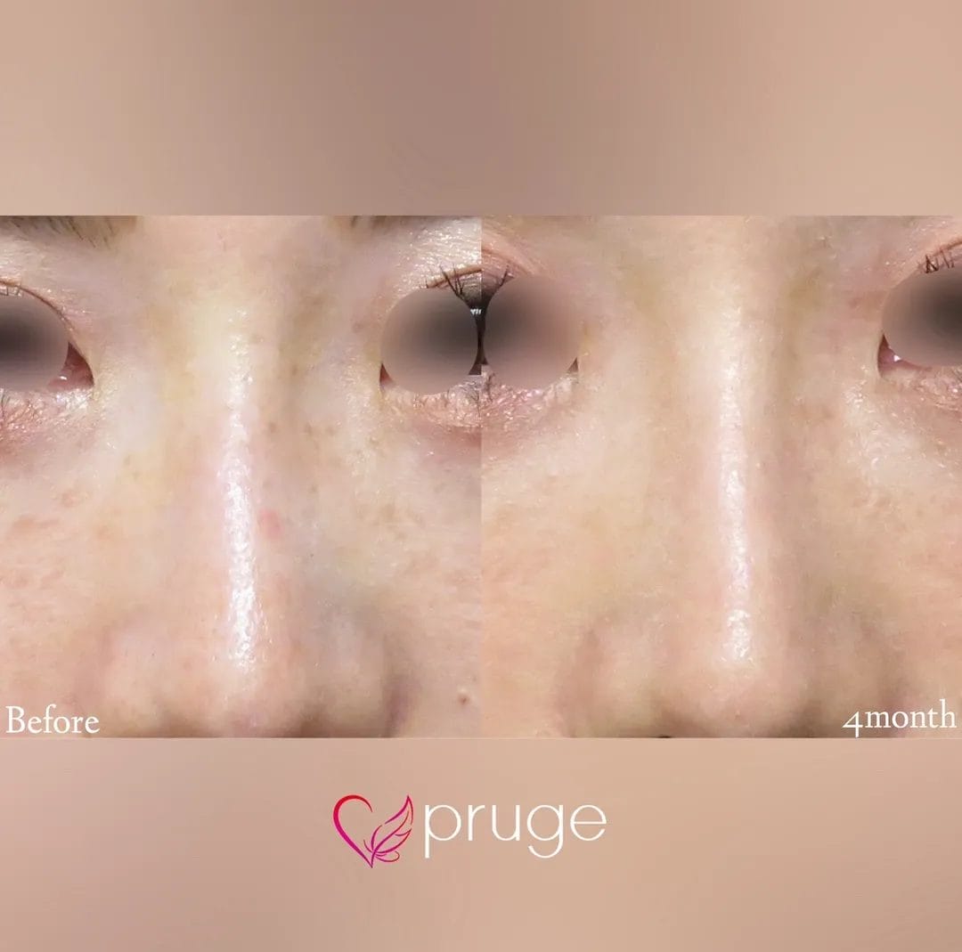 PRP注射（鼻根）