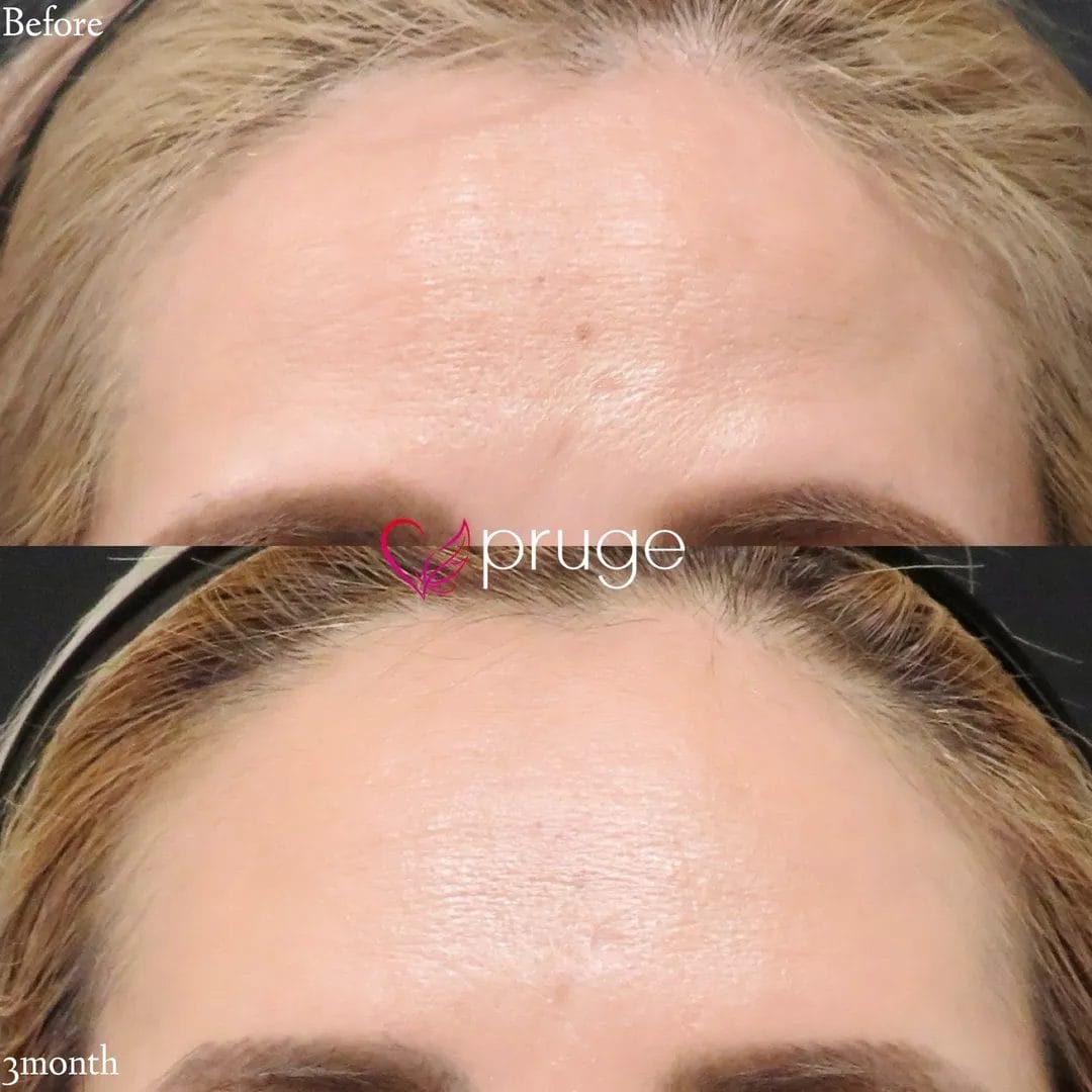 ひたい・こめかみ丸み形成