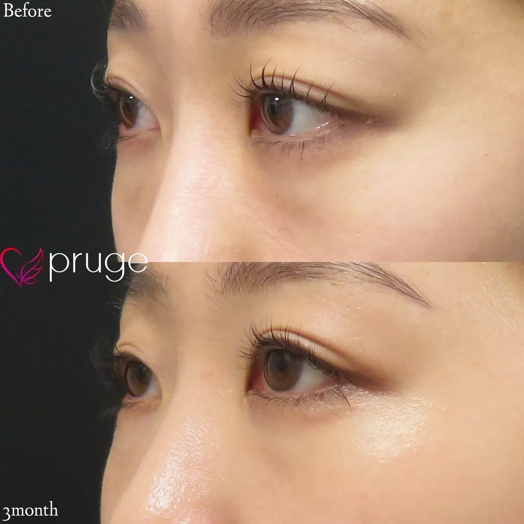 PRP注射（目の下・ゴルゴライン）