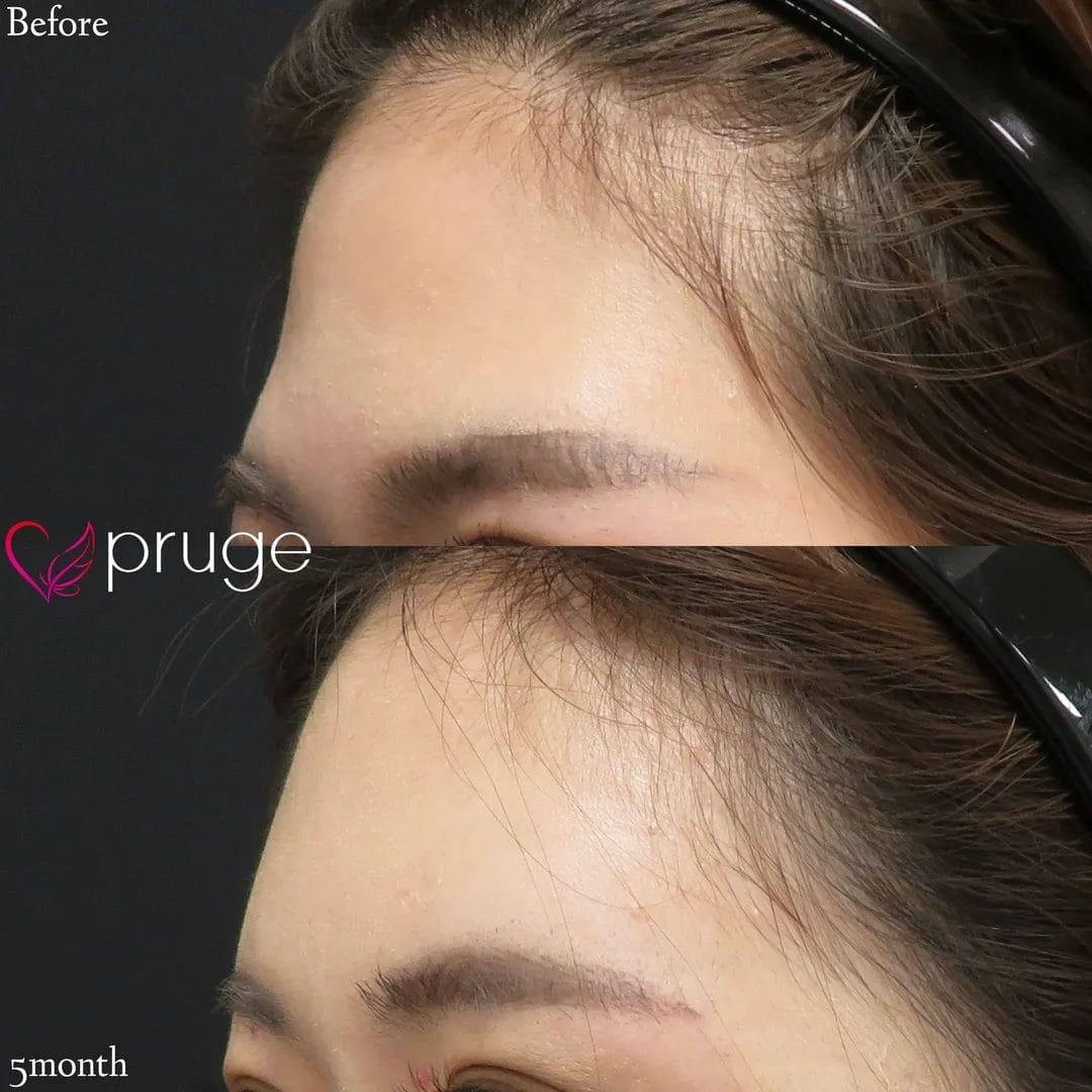 ひたい・こめかみ丸み形成