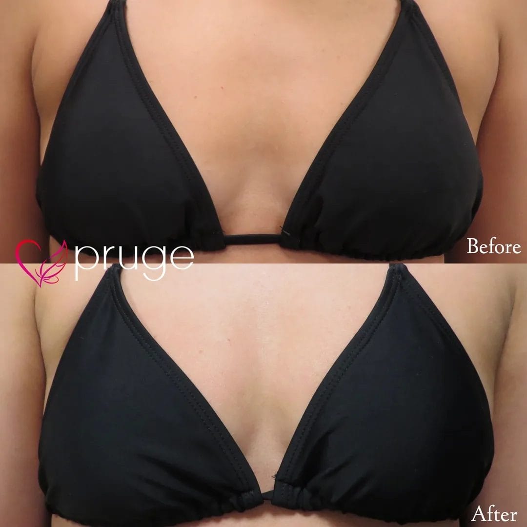 PRP注射（お胸）