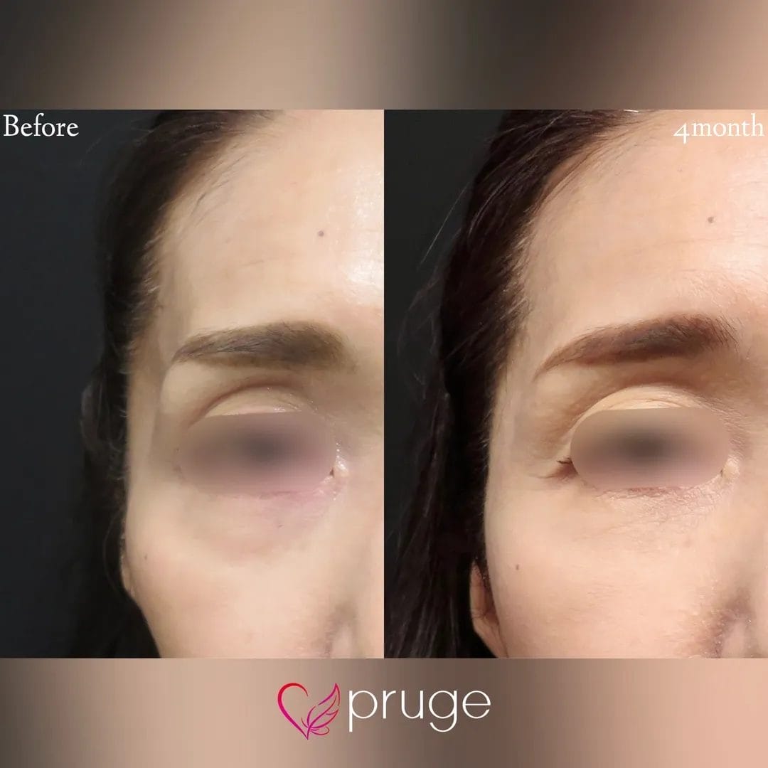 PRP注射 (こめかみ凹み)