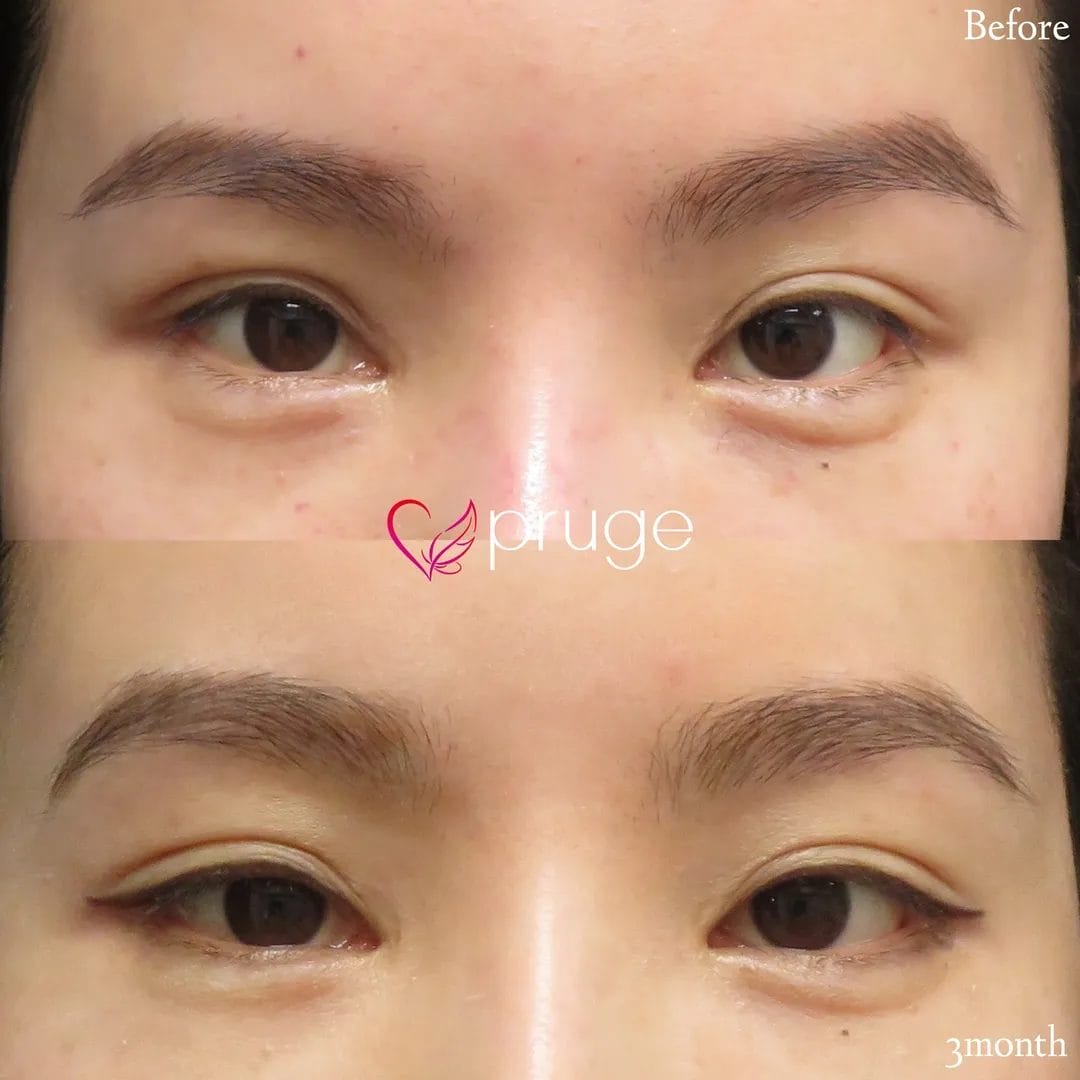 PRP注射(二重幅拡張)