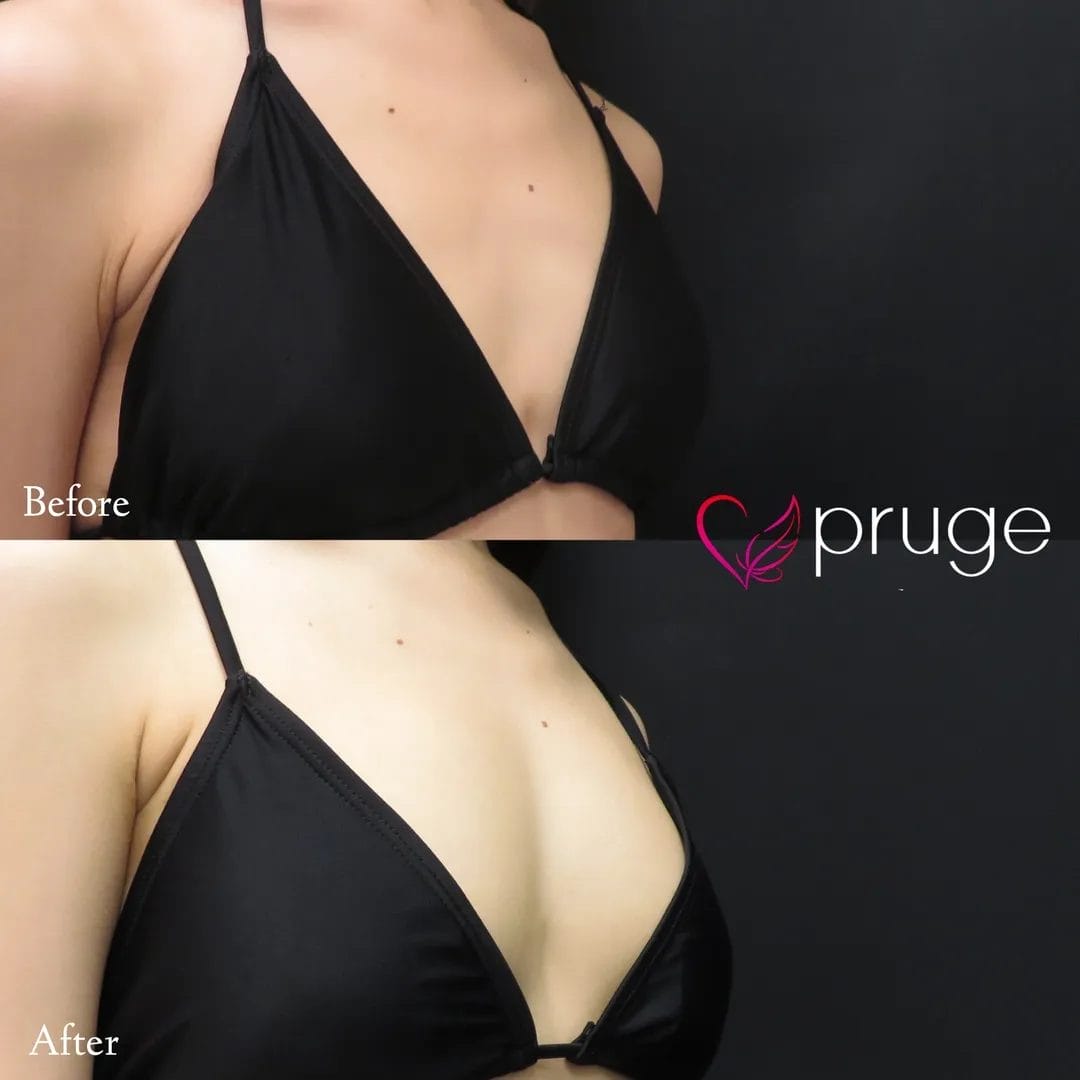 PRP注射（お胸）