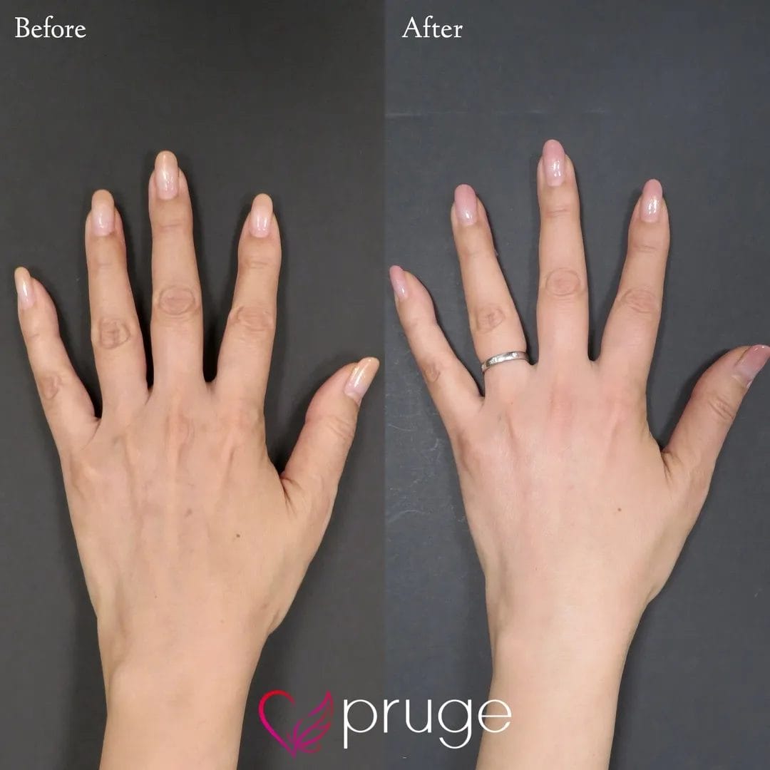 手の甲のスジ・乾燥