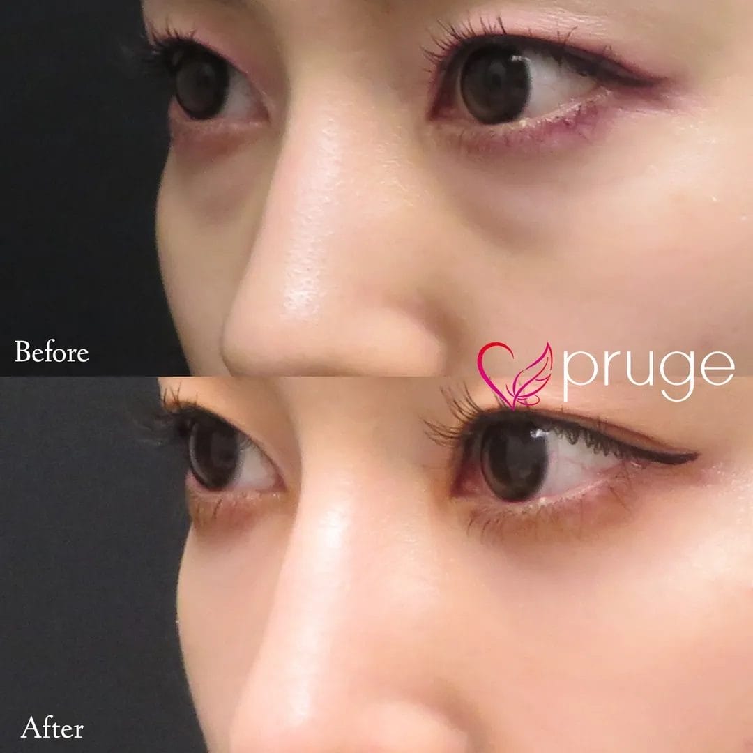 目の下のクマ・凹み