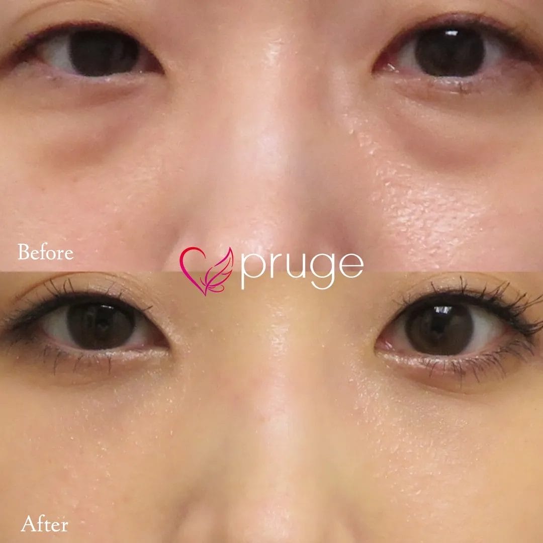 目の下のクマ・ふくらみ