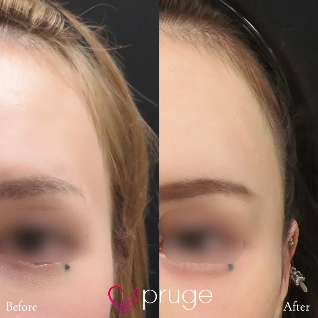 こめかみの凹み