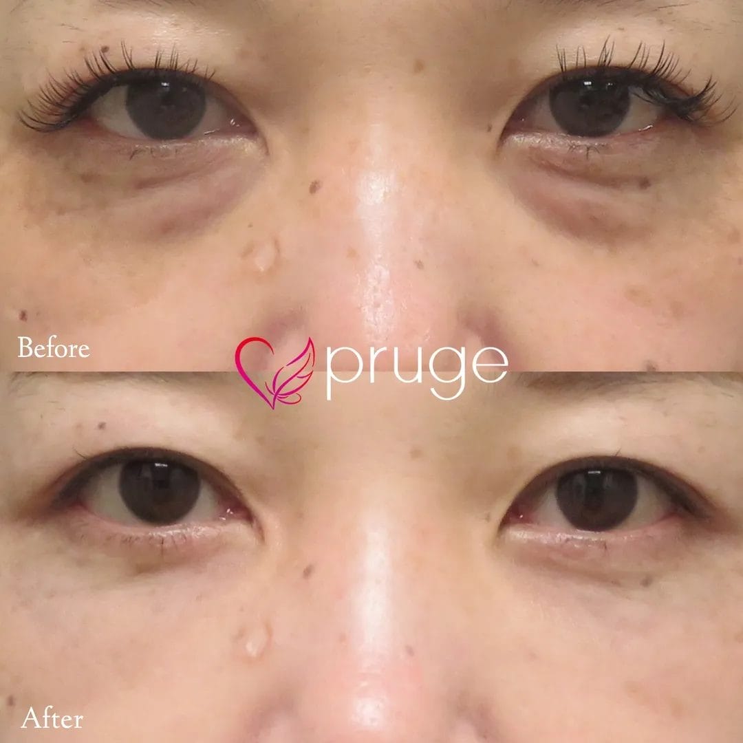 目の下のクマ・ふくらみ