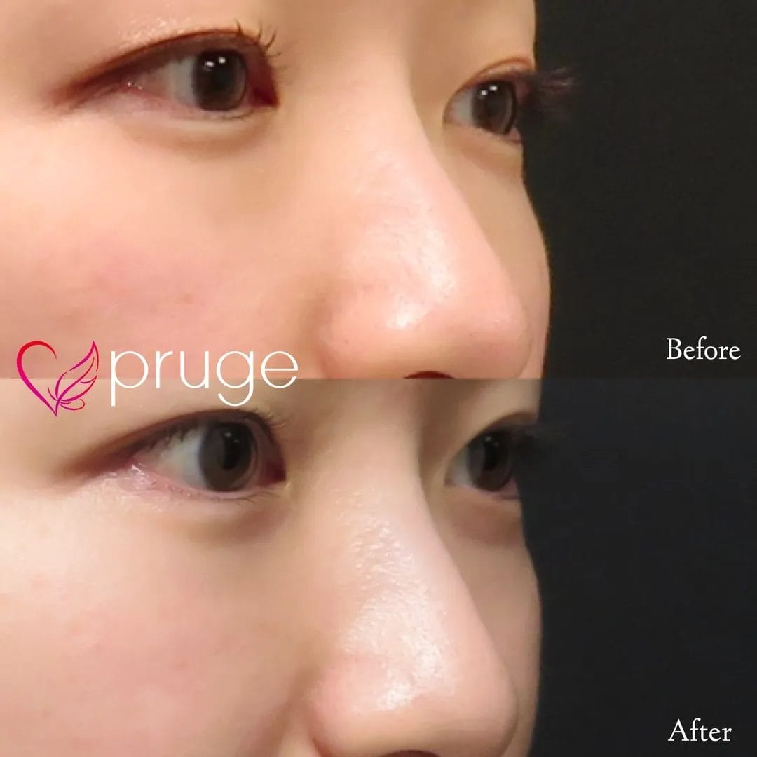 経結膜脱脂術で眼窩脂肪を取り除き、ご自身の血液から抽出したPRPを、皮下組織に注入し、組織の修復効果が得られることで、症状が改善します。