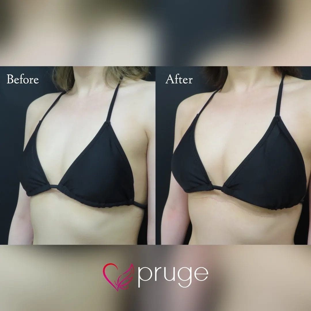 PRP注射（お胸）