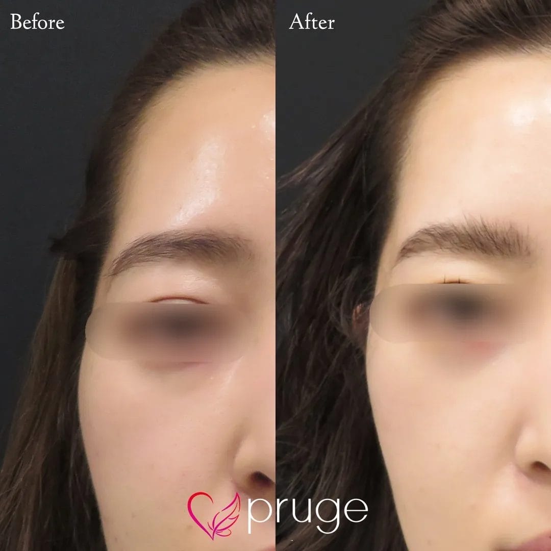 こめかみの凹み