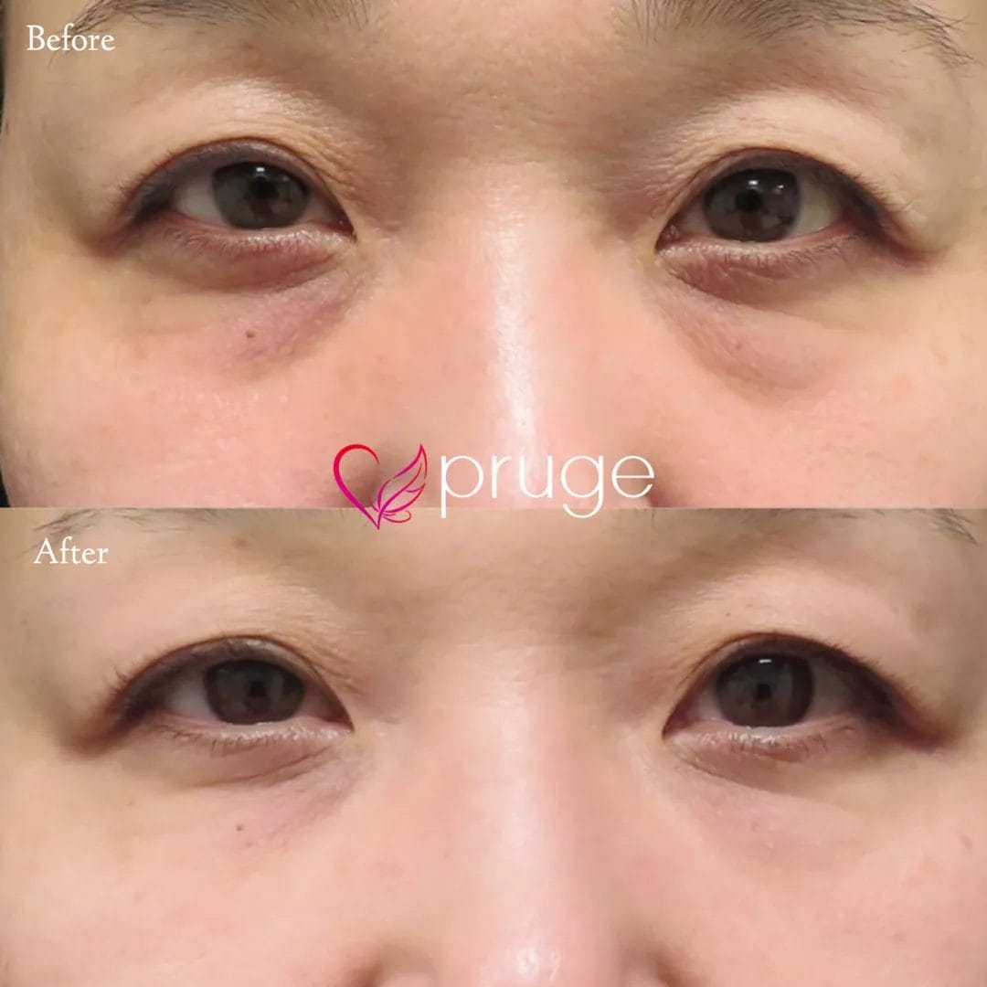 目の下のクマ・上まぶたの凹み