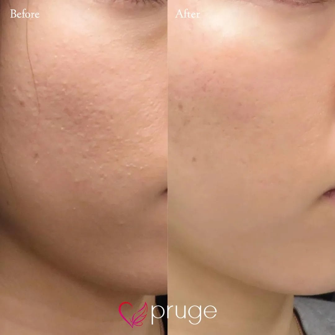 ヴァンパイアフェイシャル（両頬）