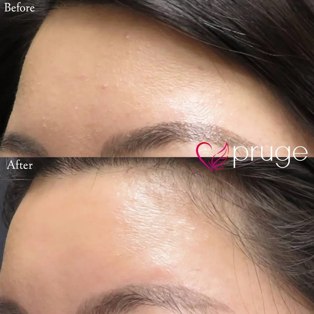 ヴァンパイアフェイシャル（額）