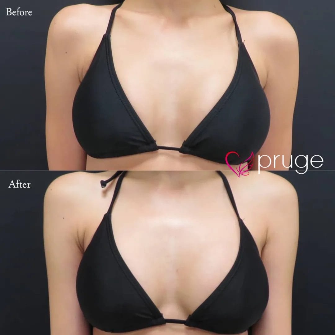 PRP注射（お胸）