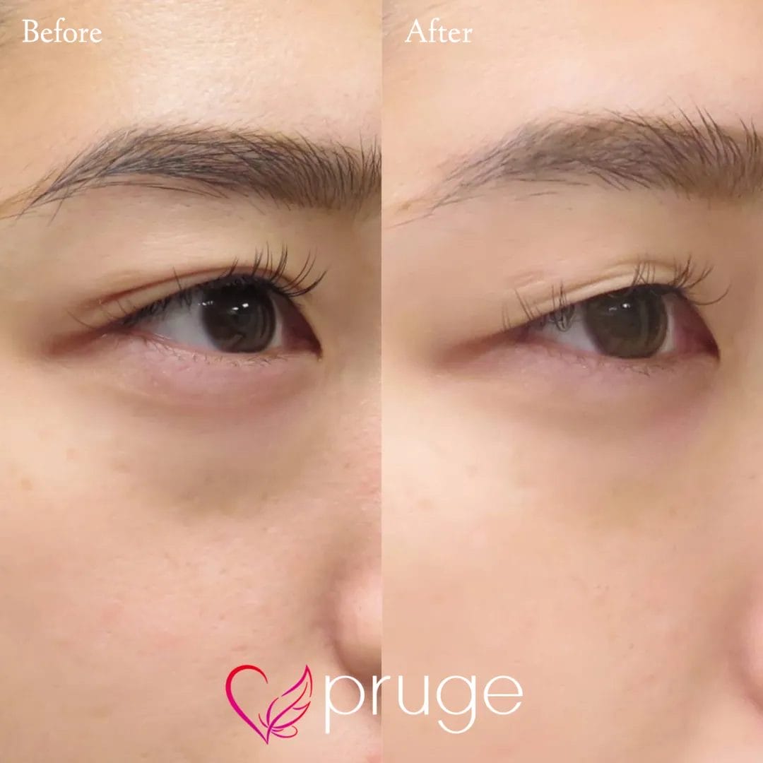 目の下のクマ・色素沈着